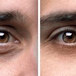 Eyebag removal and reduction