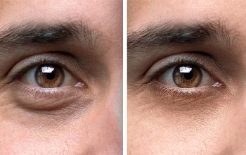 Eyebag removal and reduction