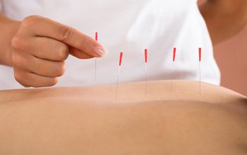 Dry Needling Shoulder: The Process Which Can Free you from the pain