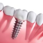 Dental Implant Cost Singapore – The Benefits Of Dental Implants